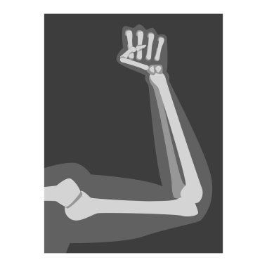 Roentgenograph of Forearm Front View Vector Image clipart