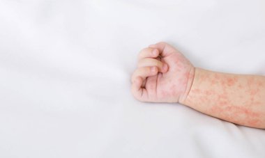 Beyaz levha üzerinde kızamık döküntüile yeni doğan bebeğin el