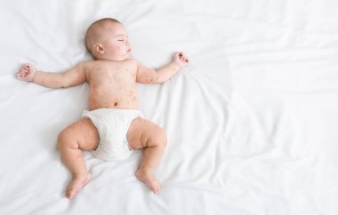 Kızamık döküntüsü yatakta uyuyan yeni doğan bebek