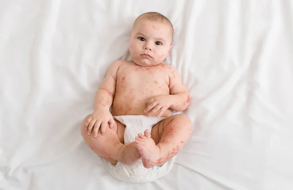 Upset newborn baby suffering from measles rash — Stock Photo, Image