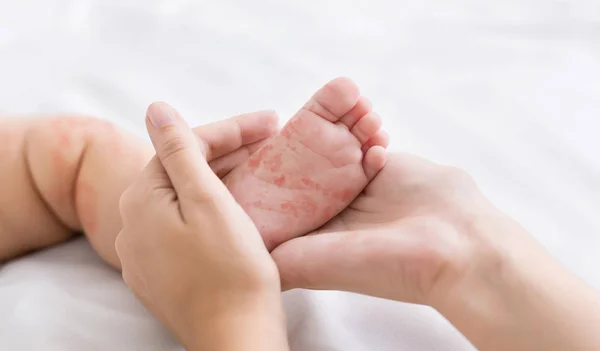 Mãe segurando minúsculo pé do bebê com erupção cutânea sarampo — Fotografia de Stock