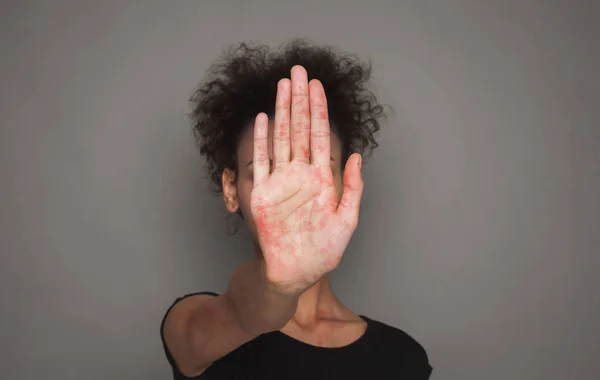 Stop mazelen virus. Afrikaanse vrouw met rode vlekken op Palm — Stockfoto