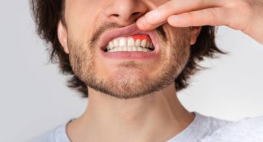 Gingival iltihap ve diş sorunları. Adam dudağını kaldırıyor ve kırmızı sakız gösteriyor.