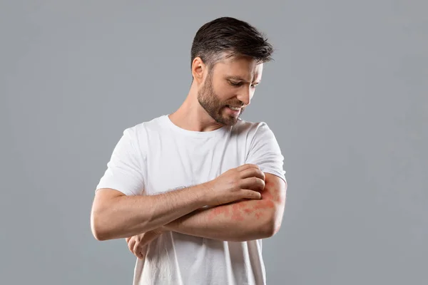 Verveelde man krabt jeuk aan zijn arm — Stockfoto