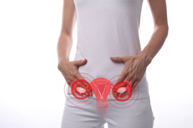 Polycystic ovary syndrome. Gynecology , female health and anatomy concept. Woman's body with uterus and ovary illustartion, isolate on white background clipart