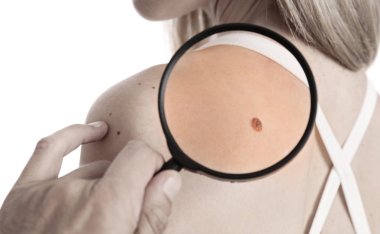 Doktor dermatolog hasta doğum izine benzer inceliyor. İyi huylu benler kontrol. Cilt etiketleri kaldırma lazer