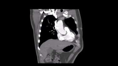 Tac eğik bir Angiotac Toraks Arteryel aşamasında