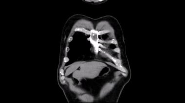 Tac koronal bir Angiotac Toraks Bazal aşamasında