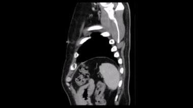 Tac sagital bir Angiotac Toraks portal aşamasında