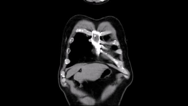 Tac en phase basale en coronaire d'un thorax angiotaque 