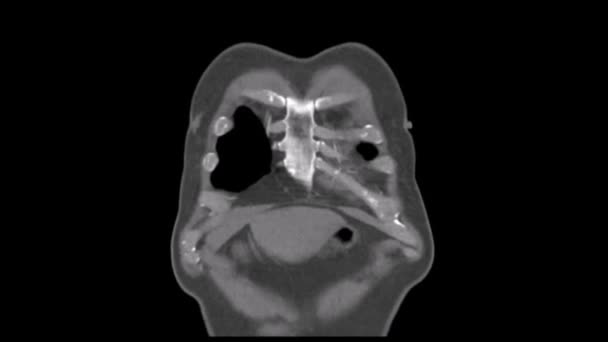 Tac en phase Portail en coronaire d'un thorax Angiotac 
