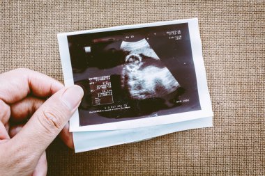 Ultrason sonogram doğmamış bir bebeğin fotoğrafı