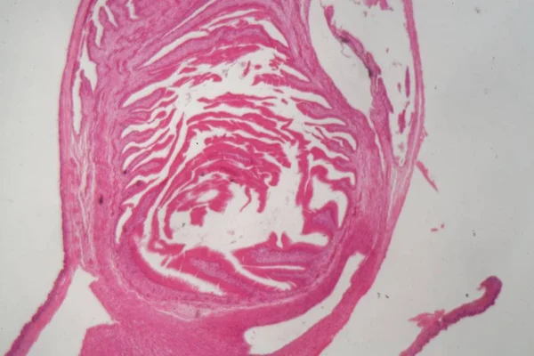 Κυδοτίδη κύστη κυκλοφυλιώδους ταινιομίδης (Εχινοκόκκος) — Φωτογραφία Αρχείου