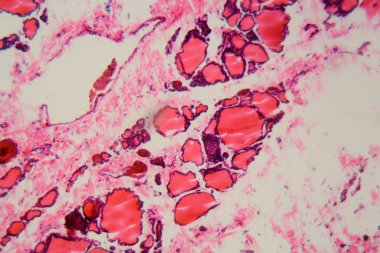 Mikroskop altında iyot eksikliğinden kaynaklanan guatürlü insan tiroid bezi