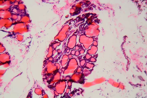 Glándula tiroides humana con bocio causada por deficiencia de yodo bajo un microscopio —  Fotos de Stock