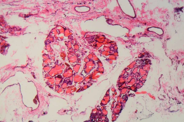 Glándula tiroides humana con bocio causada por deficiencia de yodo bajo un microscopio — Foto de Stock