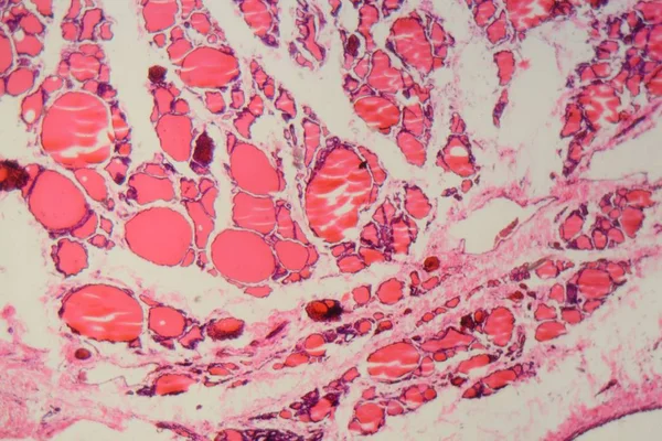 Mikroszkóp alatt fellépő jódhiány által okozott gödrös emberi pajzsmirigy — Stock Fotó