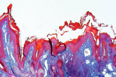 Scabies enfeksiyonu olan insan derisi, Sarcoptes scabiei, mikroskop altında ve renklendirme ile. 