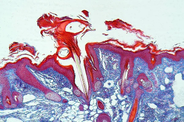 Scabies Enfeksiyonu Olan Insan Derisi Sarcoptes Scabiei Mikroskop Altında Renklendirme — Stok fotoğraf