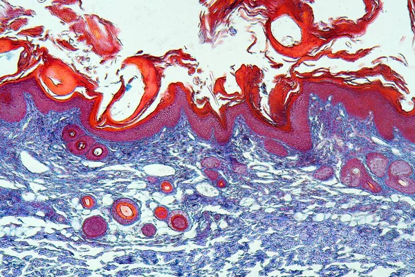 Lidská Kůže Infekcí Strupy Sarcoptes Scabiei Pod Mikroskopem Barvením — Stock fotografie