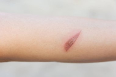 Hot wound, Arm scald, Wounds caused by scalding hot water clipart