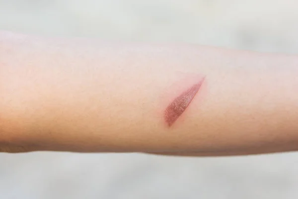 Luka panas, Arm scald, luka yang disebabkan oleh air panas mendidih — Stok Foto