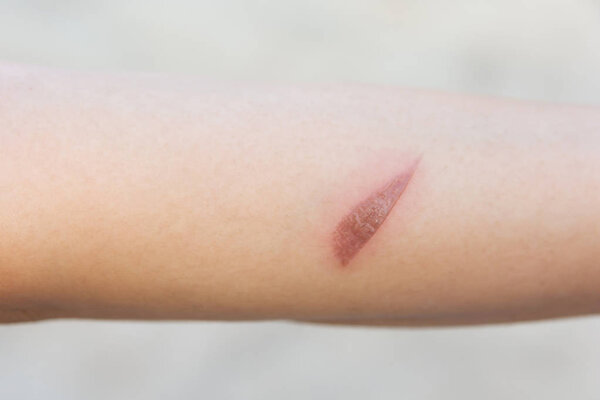 Hot wound, Arm scald, Wounds caused by scalding hot water
