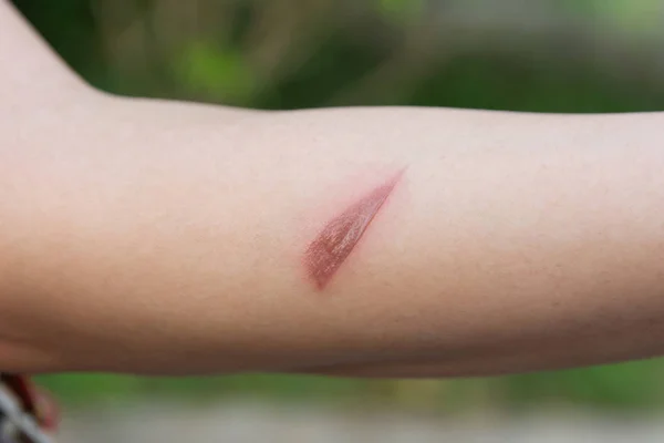 Luka panas, Arm scald, luka yang disebabkan oleh air panas mendidih — Stok Foto