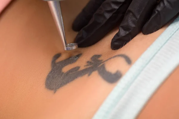 Laser Tattooentfernung Salonausstattung Stockbild