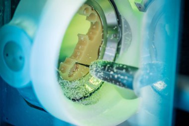 Kesme ve frezeleme diş implantı. Modern teknoloji cad cam