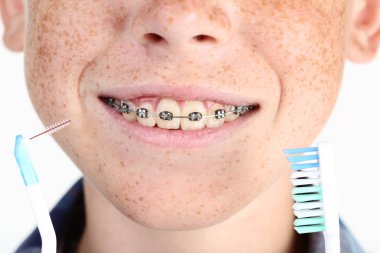 Young boy with dental braces and toothbrushes clipart