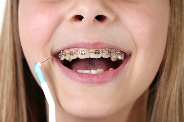 Chica Joven Con Frenos Cepillo Dientes — Foto de Stock