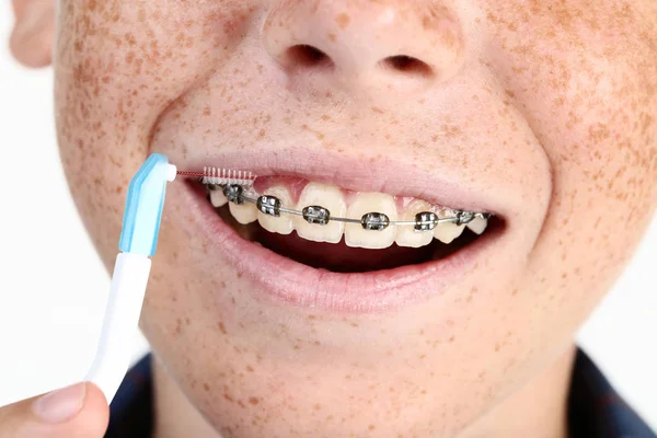 Młody Chłopak Aparatów Zęby Szczoteczki Zębów — Zdjęcie stockowe