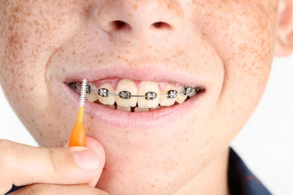 Niño Con Frenos Dentales Cepillos Dientes — Foto de Stock
