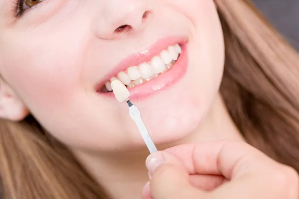 Beschattungsführung Weiblichen Mund Verwenden Das Furnier Der Zahnkrone Überprüfen — Stockfoto