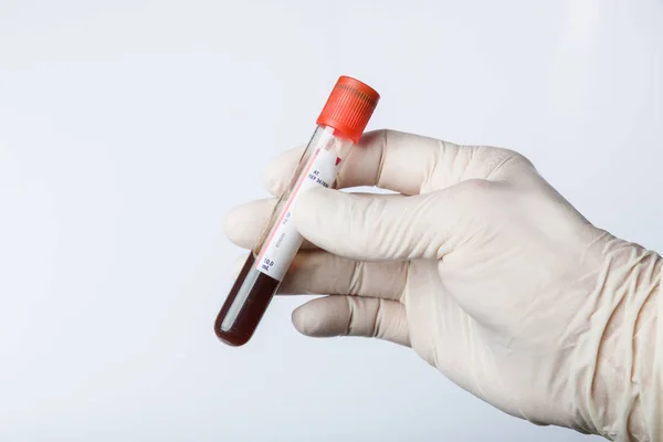 Mão Com Luvas Médicas Segurando Uma Sonda Sangue Laboratório — Fotografia de Stock
