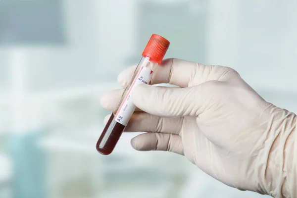 Mão Com Luvas Médicas Segurando Uma Sonda Sangue Laboratório — Fotografia de Stock