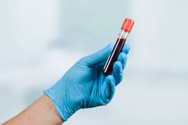 Doctors Hand Medical Gloves Blood Probe — Stock Photo, Image