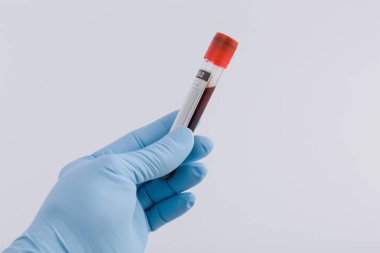 Doktorlar el Medikal eldiven ile bir kan sonda tutar