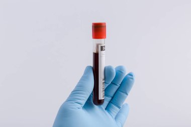 Doktorlar el Medikal eldiven ile bir kan sonda tutar