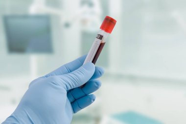 Doktor el Medikal eldiven ile bir kan sonda ve laboratuvar arka planda tutar