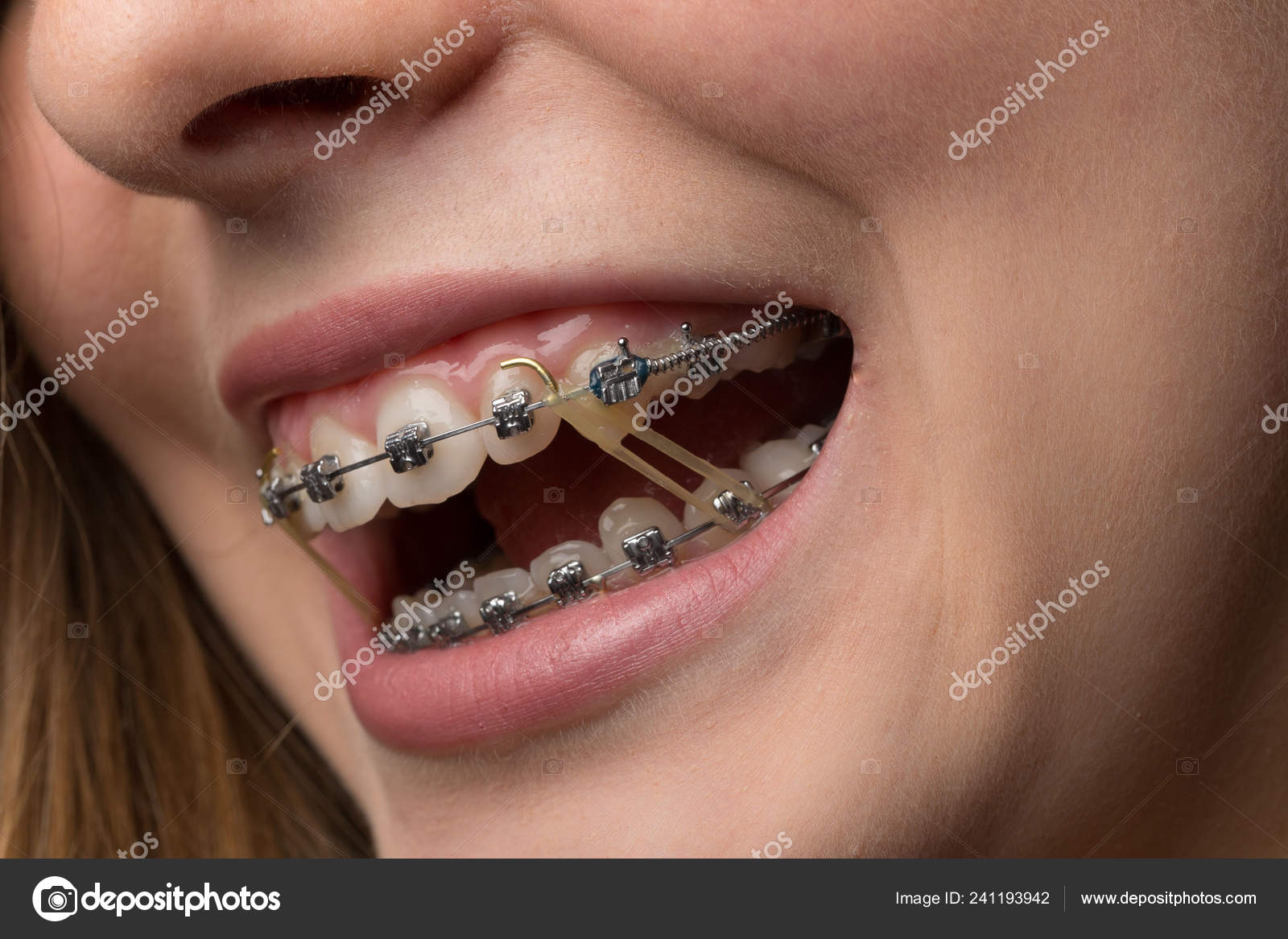 Teenagers Mouth Dental Bracket Fixing Rubber Stock Photo by