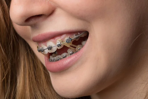 Tonåringar Mun Med Dental Fäste — Stockfoto