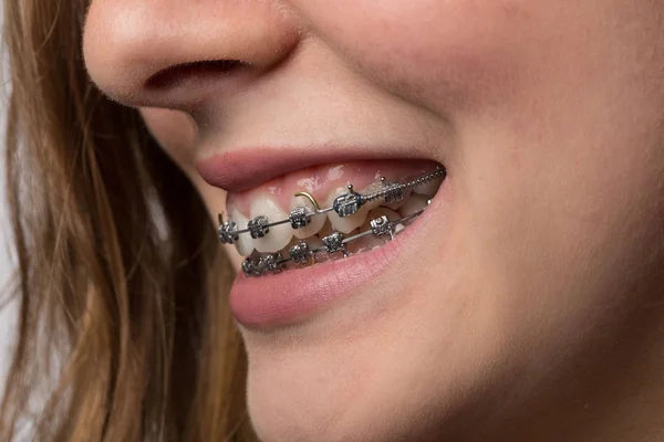 Teenager Mund Mit Zahnschiene — Stockfoto