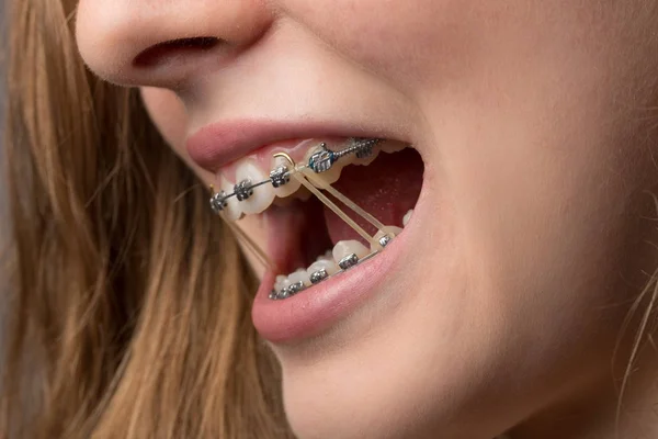 Teenager Mund Mit Zahnhalterung Und Befestigungsgummi — Stockfoto