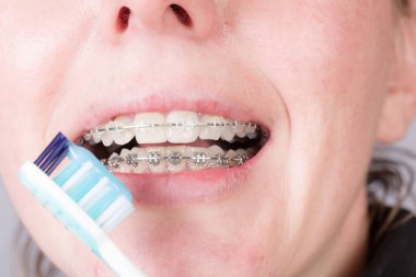 ağız bir diş destek ve bir diş fırçası ile bir kadının