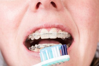 ağız bir diş destek ve bir diş fırçası ile bir kadının