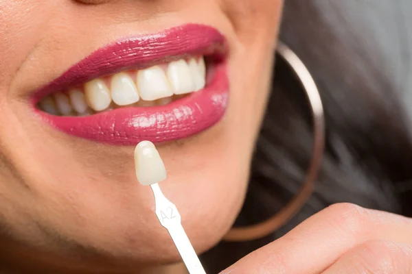 Используя Направляющие Тени Рту Женщины Проверить Шпон Зубной Короны — стоковое фото