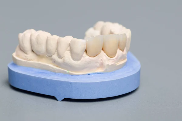 Dentición artificial en una huella dental en un laboratorio dental — Foto de Stock