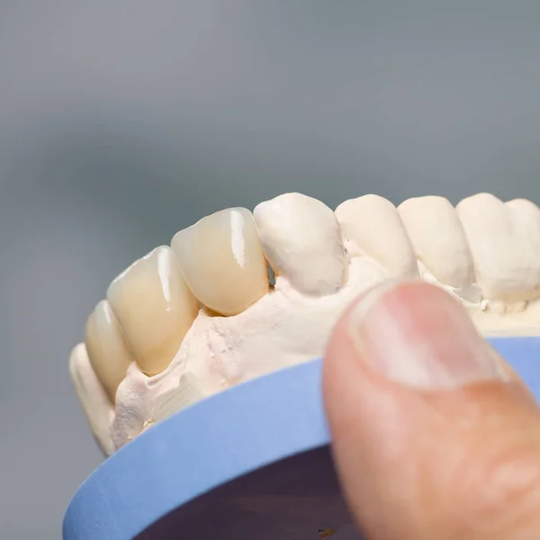 Primo piano della dentizione artificiale su un'impronta dentale in un laboratorio dentistico — Foto Stock